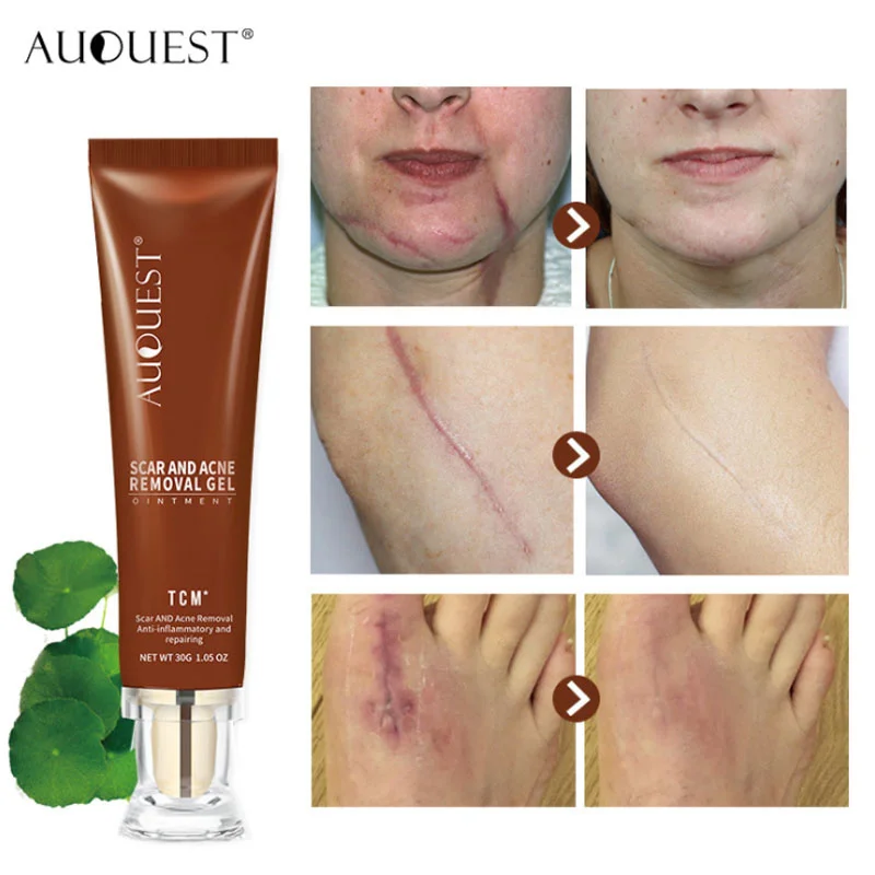 

Крем для удаления шрамов от акне, гель для восстановления шрамов, мазь для разбавления шрамов и прыщей, отбеливающий увлажняющий уход за кож...