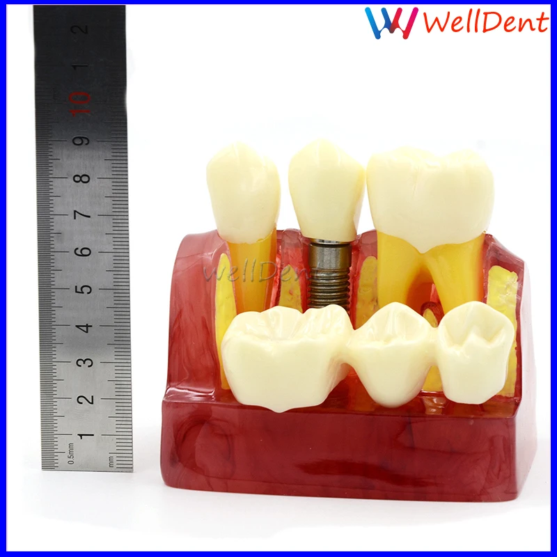 Стоматологическая зубная модель демонстрационный имплантант анализ Корона мост