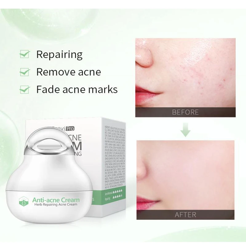 

Effective anti-acne cream treatment Fade acne spots oil control shrink pores whitening moisturizing acne Face cream skin care 8g