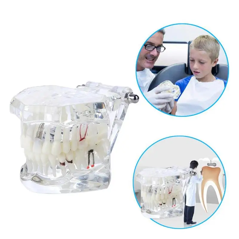 VV 1 Pcs Dental Model Teeth Implant Restoration Bridge Teaching Study Tooth Medical Science Disease Dentist Dentistry Products