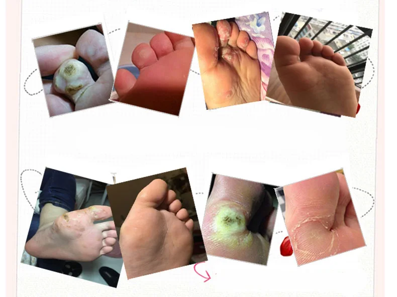 Медицинский пластырь для удаления мозолей 12 шт./лот | Красота и здоровье