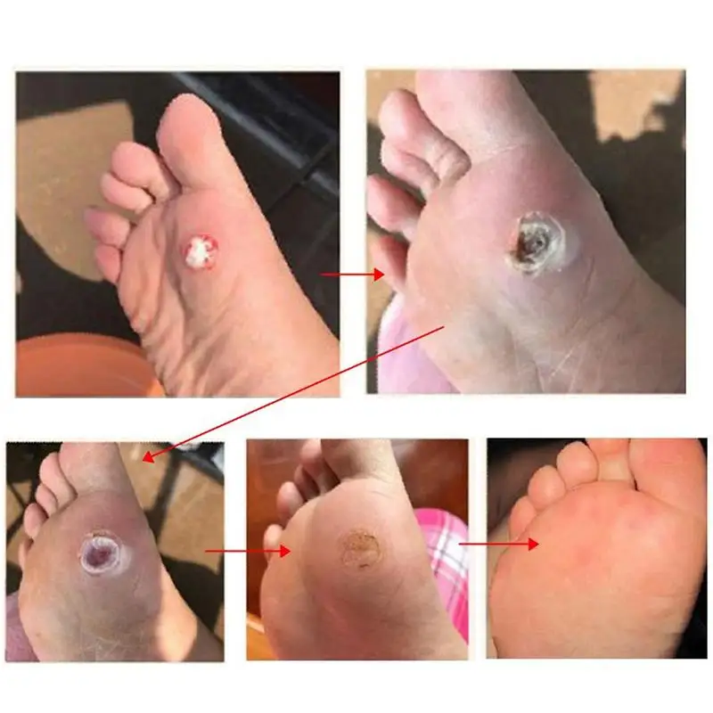 

Removes Foot Corn Killer Calluses Plantar Warts Thorn Pain Foot Protector Sticker Tool Relief Plaster Toe Medical Care