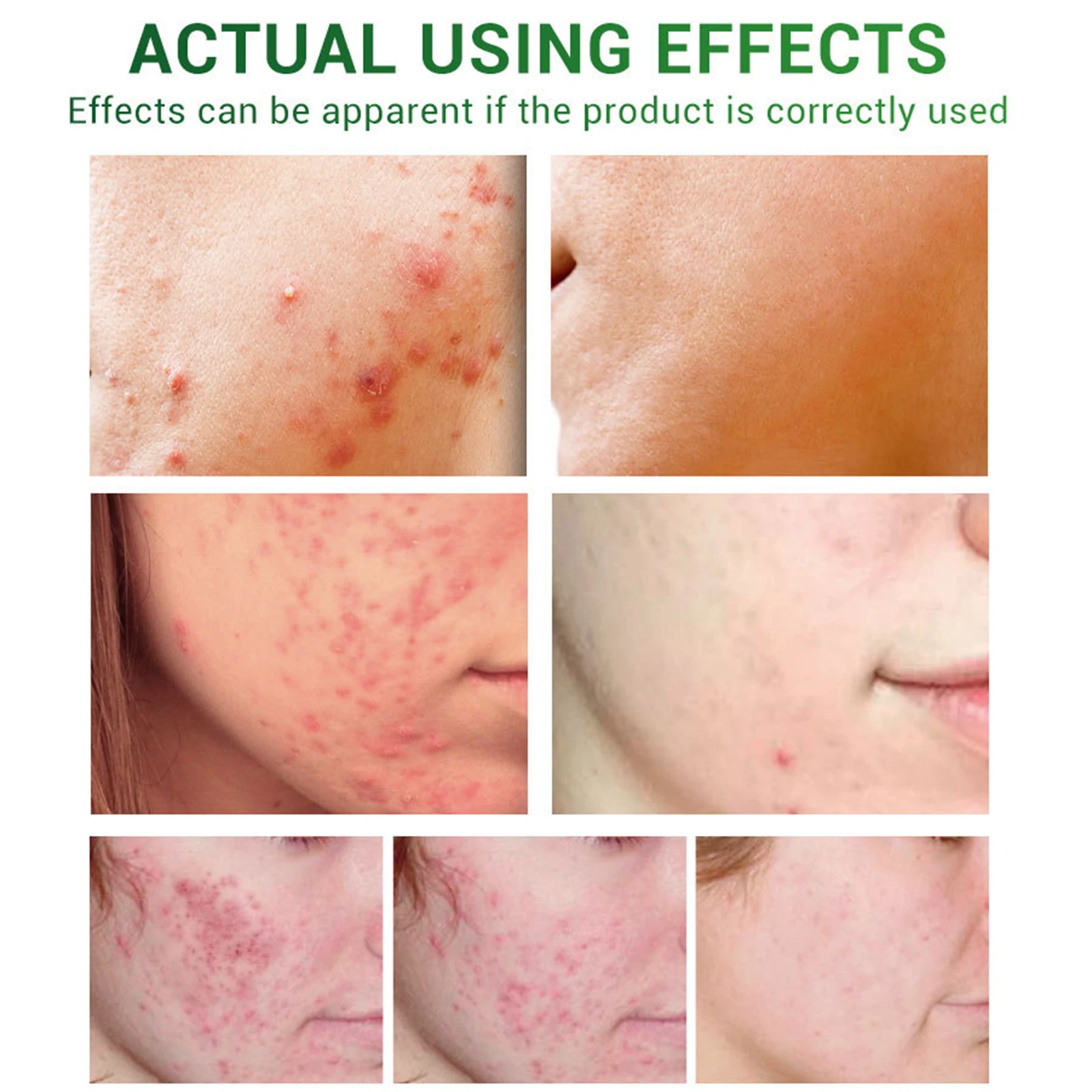 

Acne Treatment Essence Tea Tree Oil Clear Skin Essence for Clearing Severe Acne Remover Pimple Repair Skin HJL2019