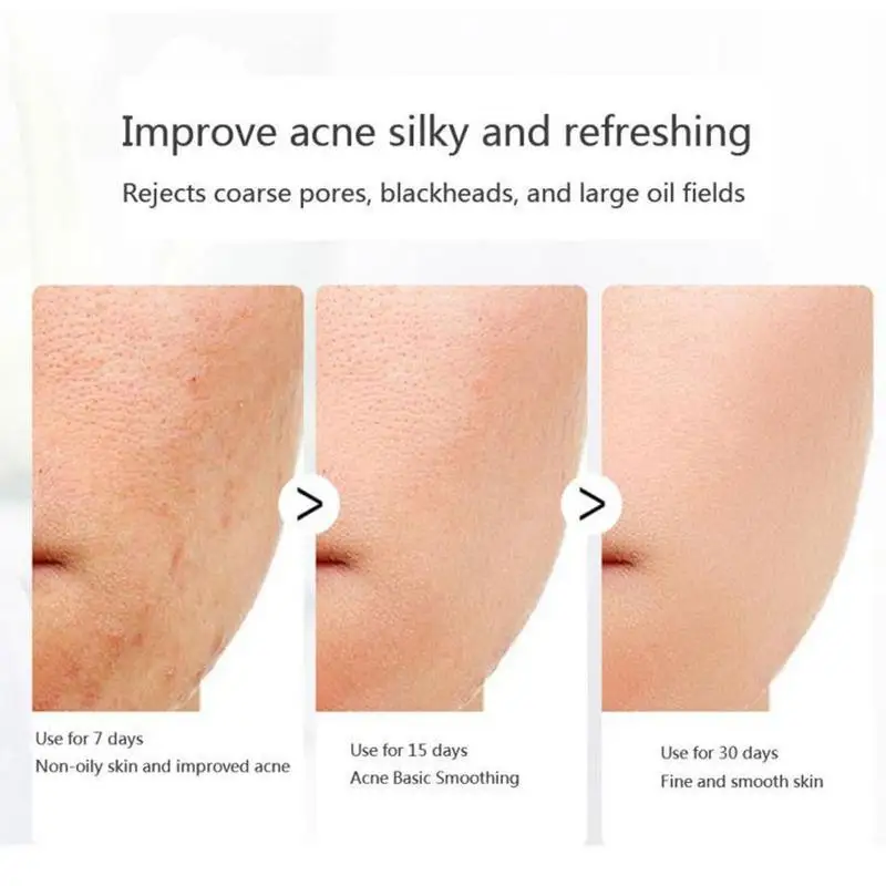 

Mite Removal Soap Brushed Cheese Soap Removal Pimple Cleansing Acne Treatment Soap Face Handmade Care Control Oil V0M1