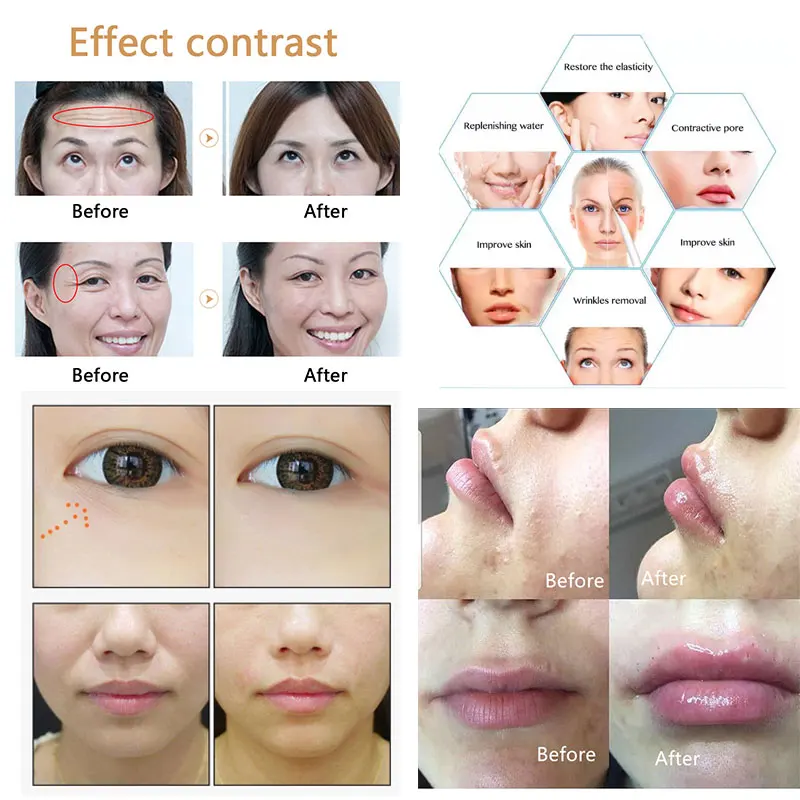 

Hyaluronic acid Pen Massage Atomizer High Pressure hyaluron gun Hyaluron injection tool for Anti Wrinkle Lip Filler Lip Lifting