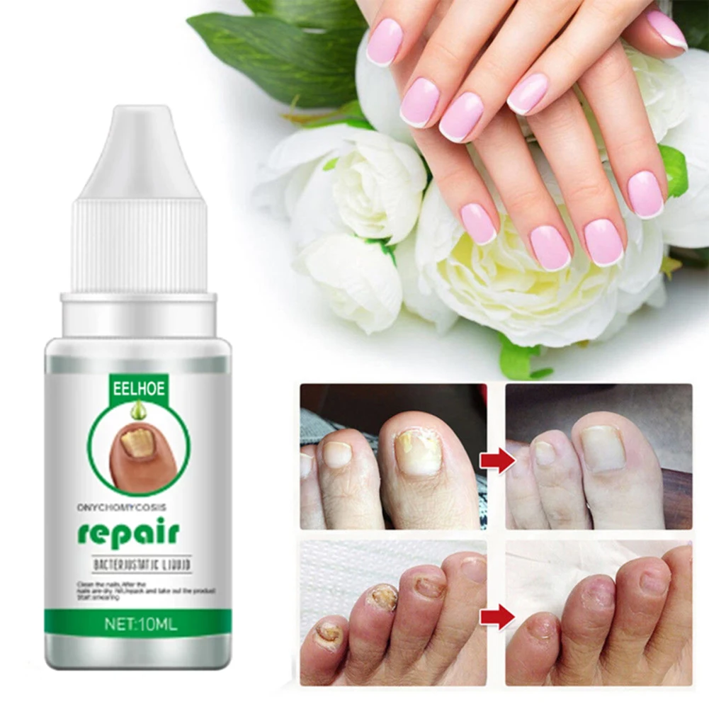 

Nail Fungal Treatment Serum Fungal Fingernails and Toenails Repair Promote New Growth Renew Cracked Fungal Nails Solution