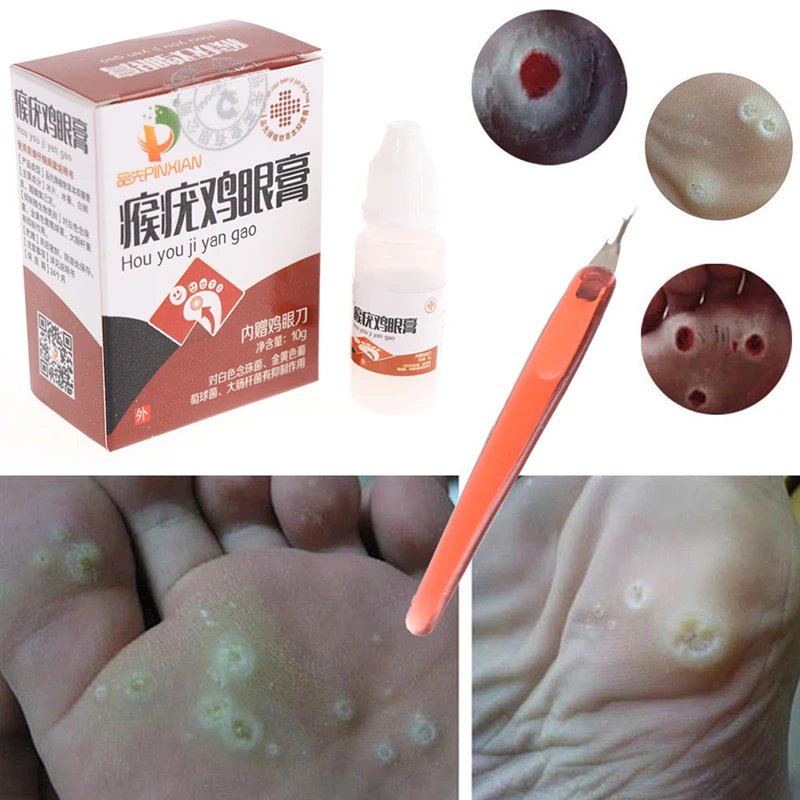 

Средство для удаления бородавок, бородавок и бородавок, 10 мл