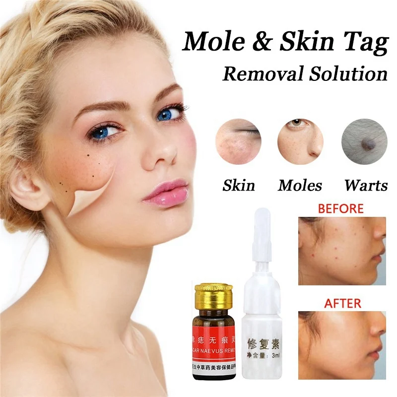

Mole Removal Cream Freckle Removal Cream Face Care Repair Solution Removal Solution Painless 3.0ml Professional Acne Treatment