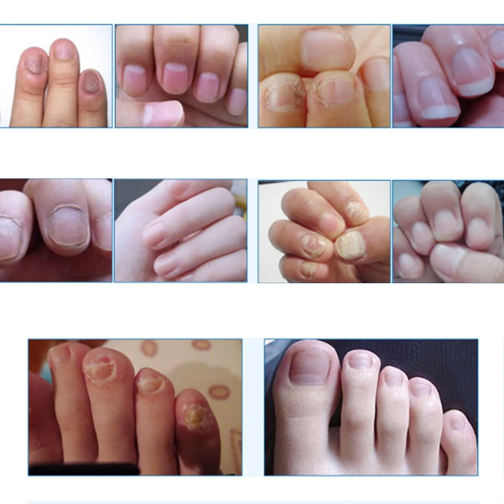 3 мл китайская медицина травы Лечение грибка ног ногтя против грибкового