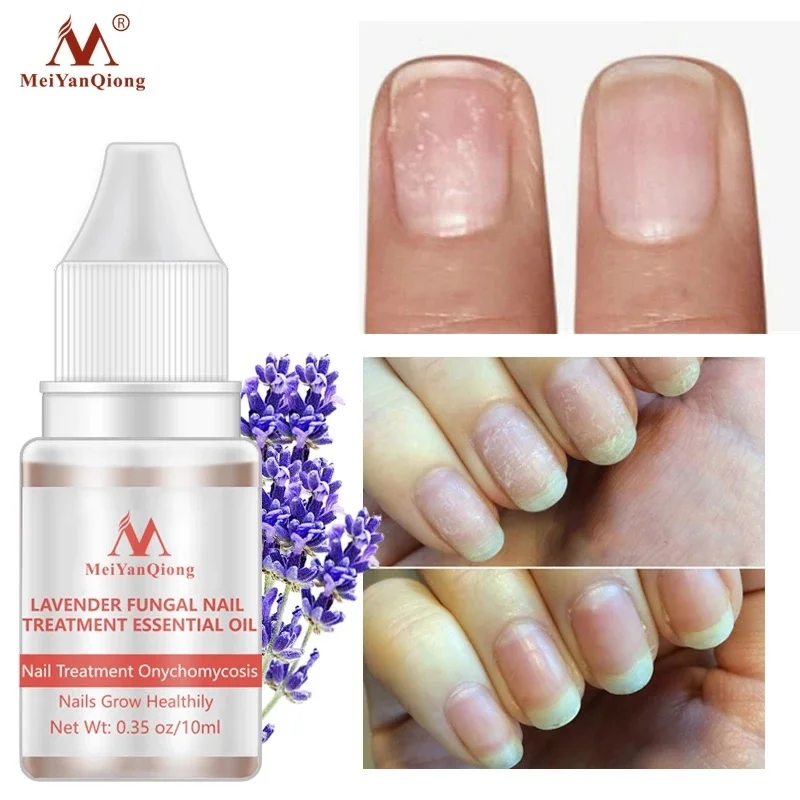 

MeiYanQiong Fungal Nail Treatment Essence Feet Care Removal Fungus Healthy Repair Serum Anti Infection Paronychia Onychomycosis