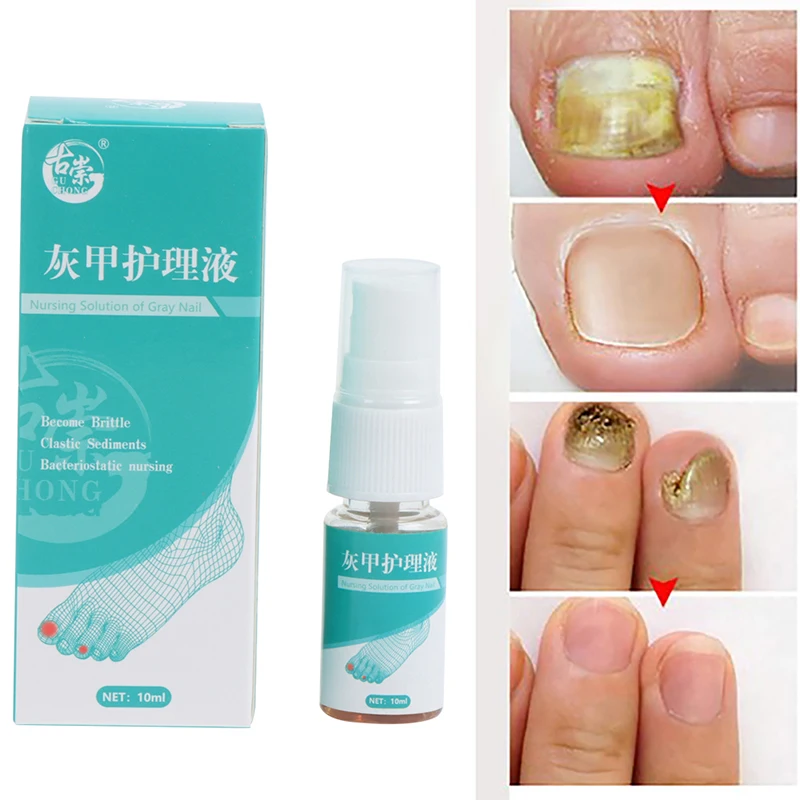 

Nail Fungal Treatment Essence Nail Foot Whitening Toe Nail Fungus Removal Gel Anti Infection Paronychia Onychomycosis Feet Care