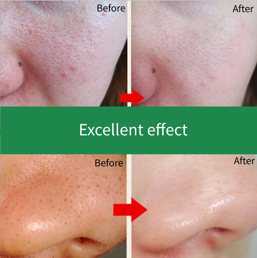 Уход за кожей лица Сыворотка для удаления черных точек Глубокая очистка черная