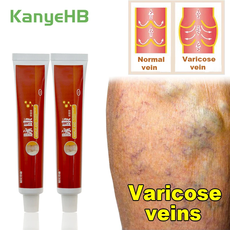 

2Pcs Varicose Veins Treatment Cream Varicosity Angiitis Remedy Ointment Relief Phlebitis Legs Arm Vasculitis Angiitis Cream A428