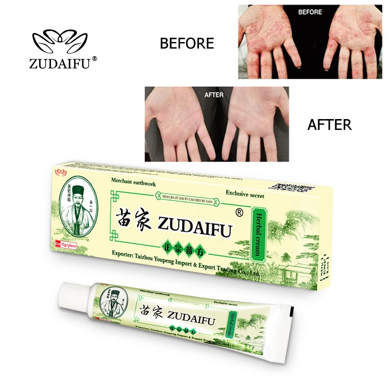 

Оригинальный крем ZUDAIFU для тела от псориаза, 10 шт., 15 г, уход за кожей, мазь от дерматита, экзематоида, экземы, лечение, оптовая продажа