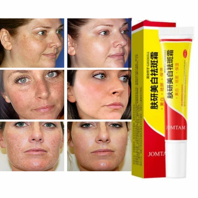 

Effective Whitening and Anti-freckle Cream To Remove Chloasma Acne Spots Melanin Dark Spots Pigmentation and Moisturizing