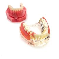 dental implant restoration teeth model removable bridge denture teaching research model for dentistry students