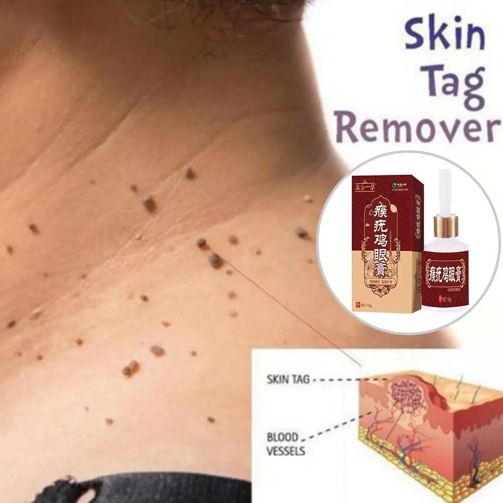 

10ml Skin Tag Remover Wart Treatment Instant Anti Foot Rapidly Removal Corn Warts Removes Moles N8E1