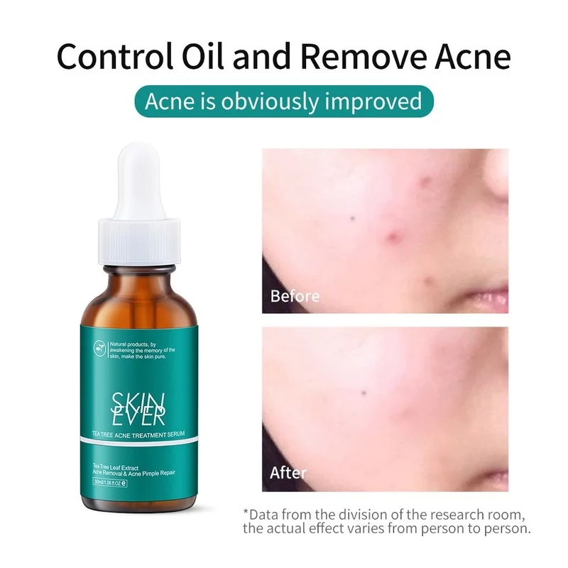 

Tea Tree Essence Reduces Facial Acne Treats Blackheads Original Liquid Repairs and Brightens Facial Liquid Moisturizing Cream