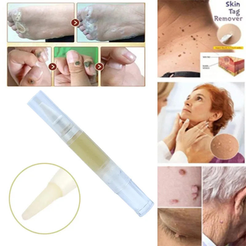 Средство для лечения бородавок жидкость удаления с бирок кожи удаление от бровей