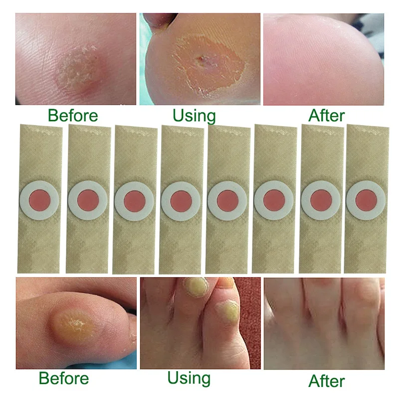Горячие 5 шт. медицинские мозоли подошвенные бородавки шип штукатурка устройство