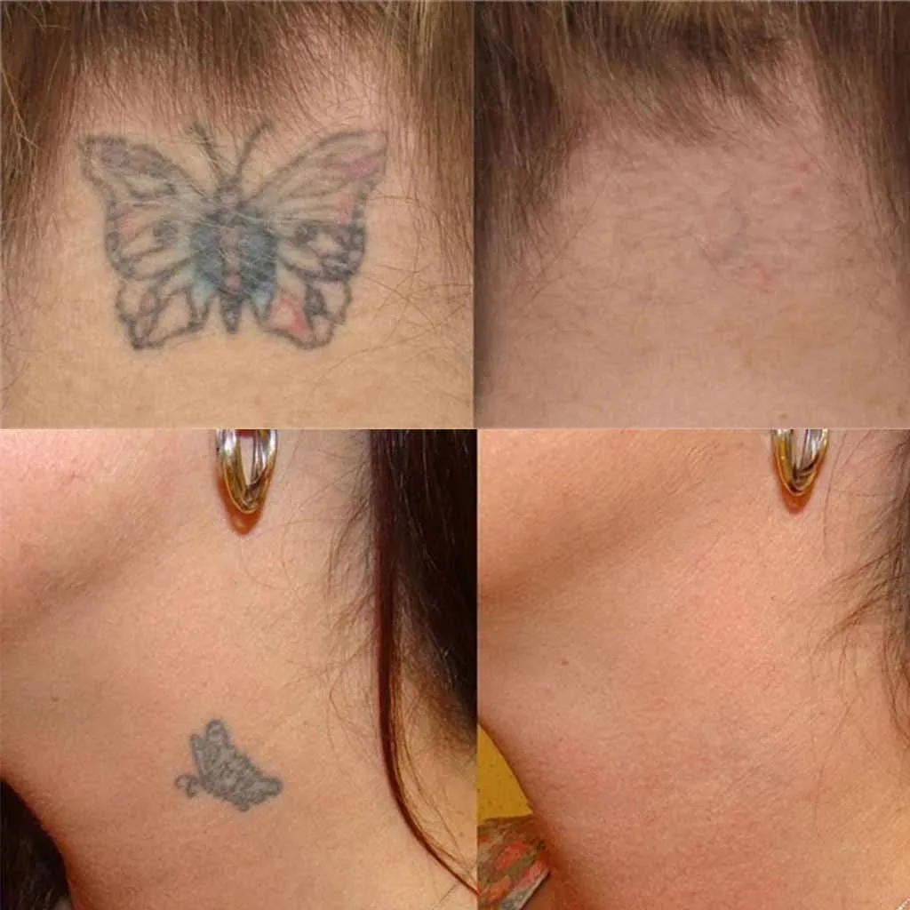 

HAICAR Beauty Tools Permanent Tattoo Removal Cream No Need For Pain Removal Maximum Strength removes unwanted tattoos pain-free