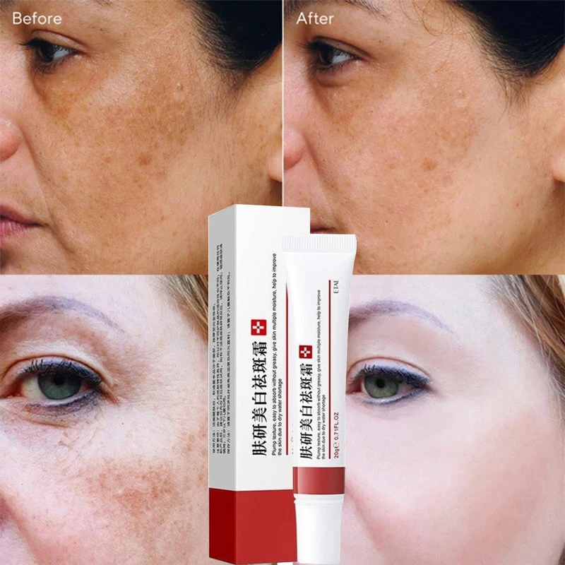 

Whitening Cream Remove Spots Acne Improve Dark Yellow Skin Freckle Cream Fade Scars Pigmentation Melasma Brighten Skin Care 20g