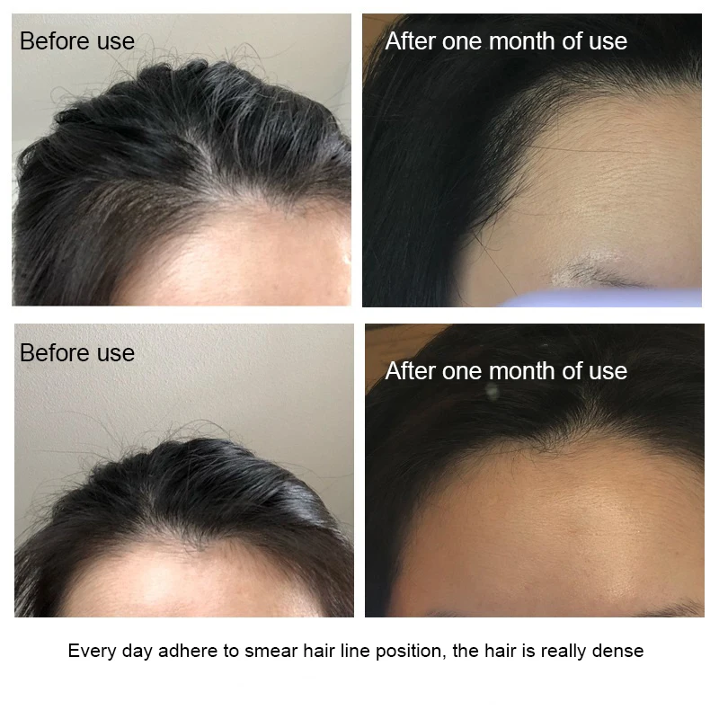 

60ml Polypeptide Hair Generating Essence Fast Hair Growth Serum Essential Oil Restoration Hair Loss Serum original Hair Care