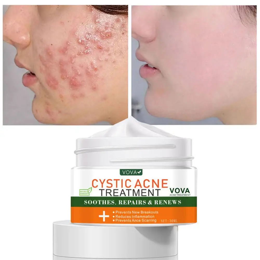 

Effective Acne Scar Removal Cream Acne Treatment Fade Acne Spots Remover Oil Control Shrink Pores Anti Body Acne Free Acne Cream
