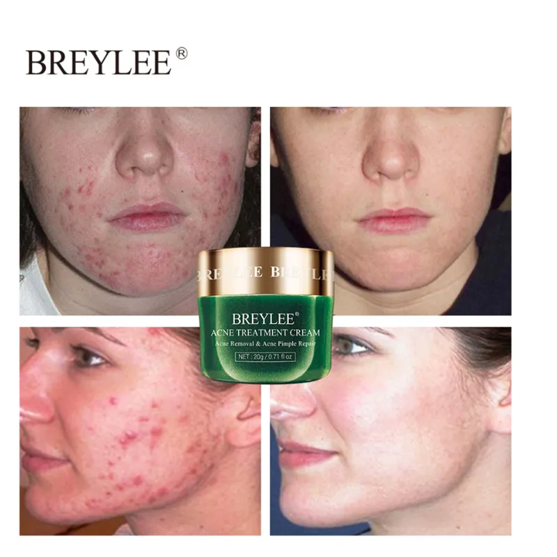 BREYLEE 20 г уход за кожей сыворотка для лечения акне крем анти лицо Удаление прыщей