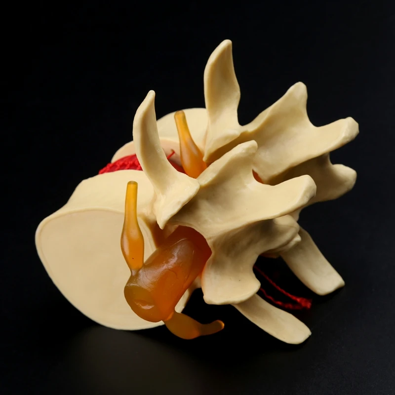 

Anatomical Spine Lumbar Disc Herniation Anatomy Teaching Tool Dropshipping