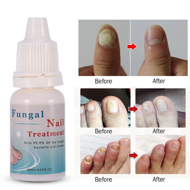 

10ML Moisturizing Nail Polish Onychomycosis Nails Repair Liquid Nourishing Liquid Armor Sterilization Treatment Nails Care TSLM1
