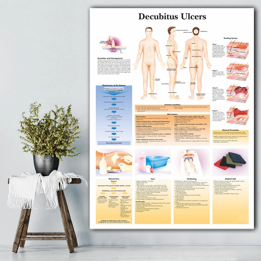 WANGART Decubitus Ulcers Chart Art Poster Print Body Map Canvas Wall Pictures for Medical Education Home Decor | Дом и сад