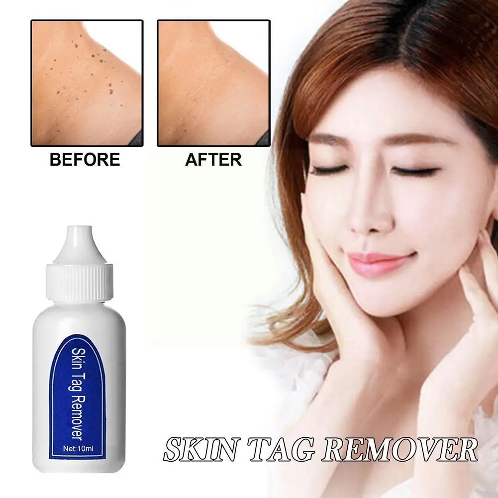 

Wart Removal Beauty Liquid Genital Wart Treatment Papillomas Liquid Warts Removal Removing Tags Skin From of Z6K8