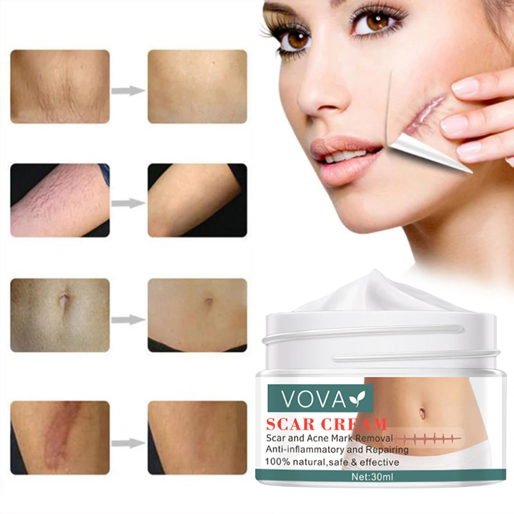 30 г крем удаляющий Шрамы Акне прямые от угревой сыпи гель для лица удаления угрей
