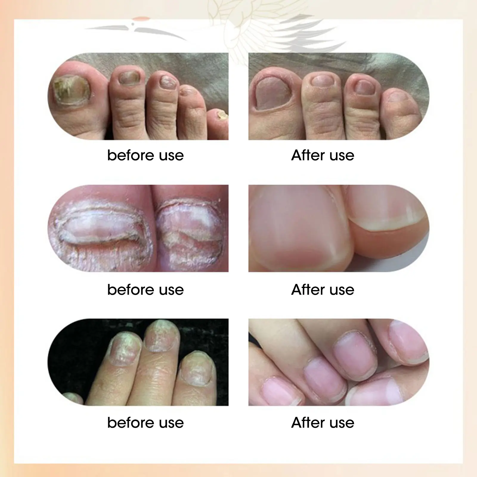 

Nail Fungal Treatment Feet Care Essence Nail Foot Whitening Toe Nail Fungus Removal Gel Anti Infection Paronychia Onychomycosis