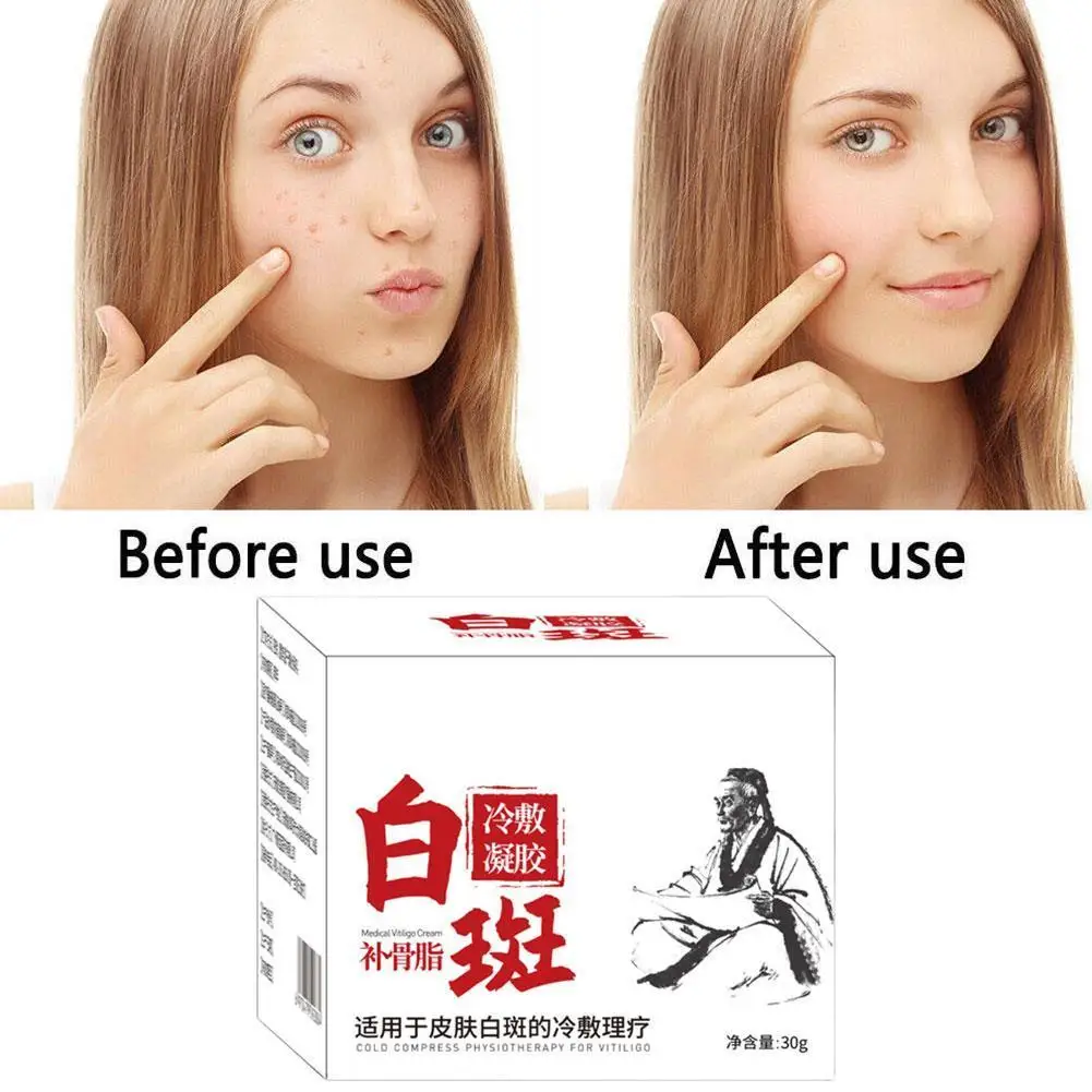 

Vitiligo Clearing Bacteria Cream Medical Melanin Promotes Vitiligo Damage Lin's Skin Vitiligo Repair Care And Treatment F8W3