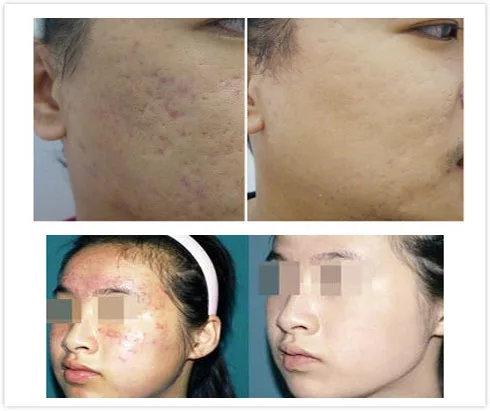 

1pcs/2pcs-Oil control, exfoliation, blackhead, acne, fine lines, 5% gel, 20g/pcs