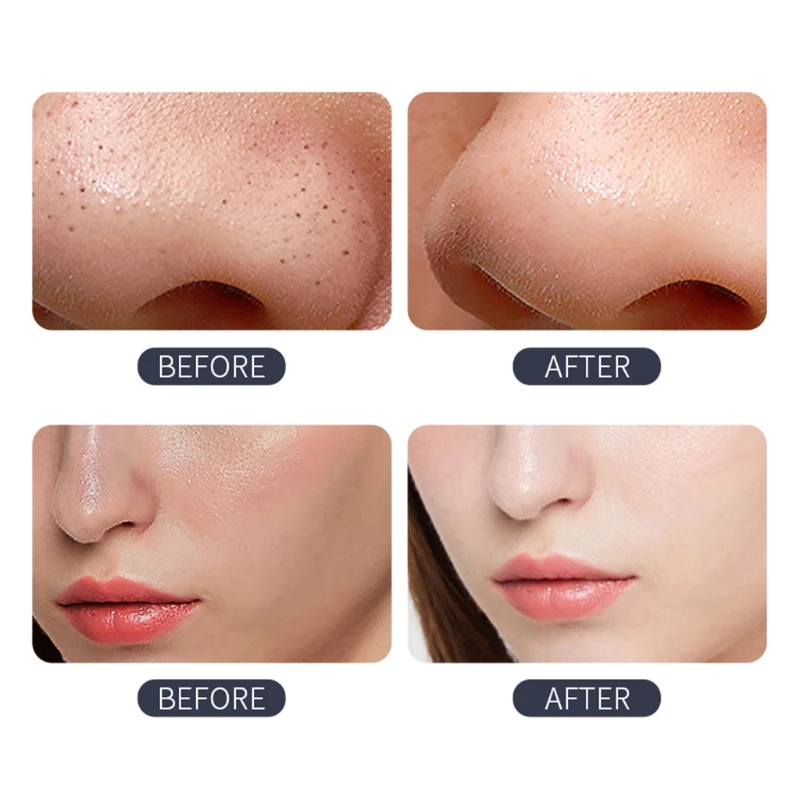 

Portable Electric Pore Vacuum Cleaner Blackhead Remover Acne Comedone Extractor Beauty Cleansing Instrument for Facial