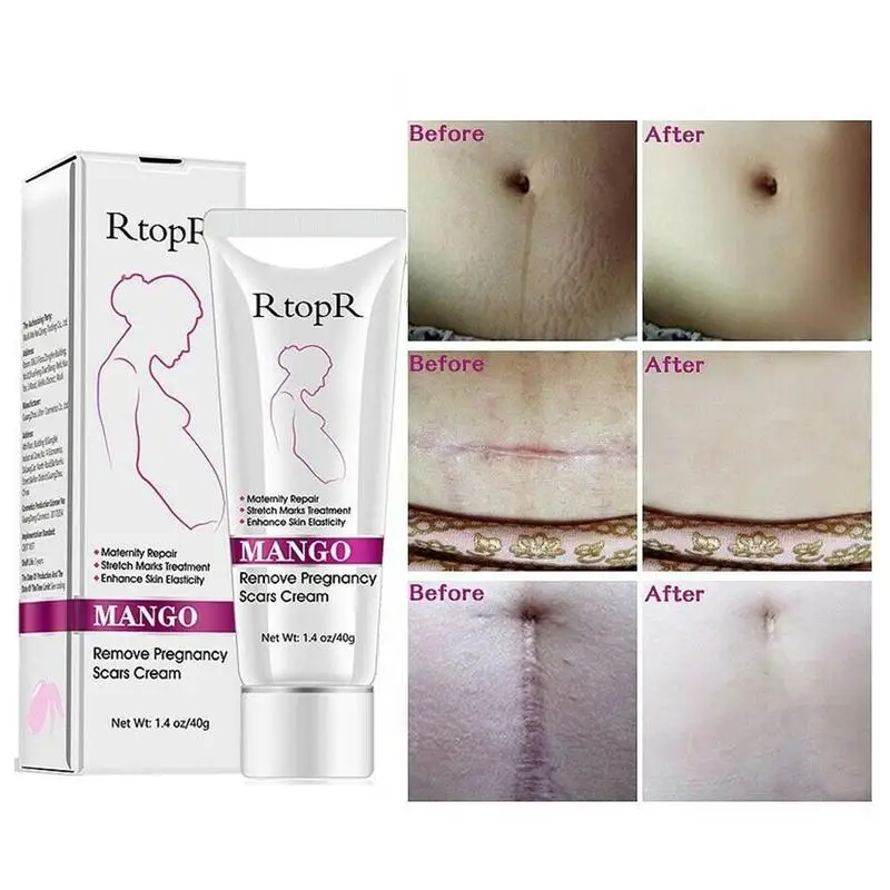 Натуральный растягивающийся крем от манго для удаления шрамов и акне мягкий не