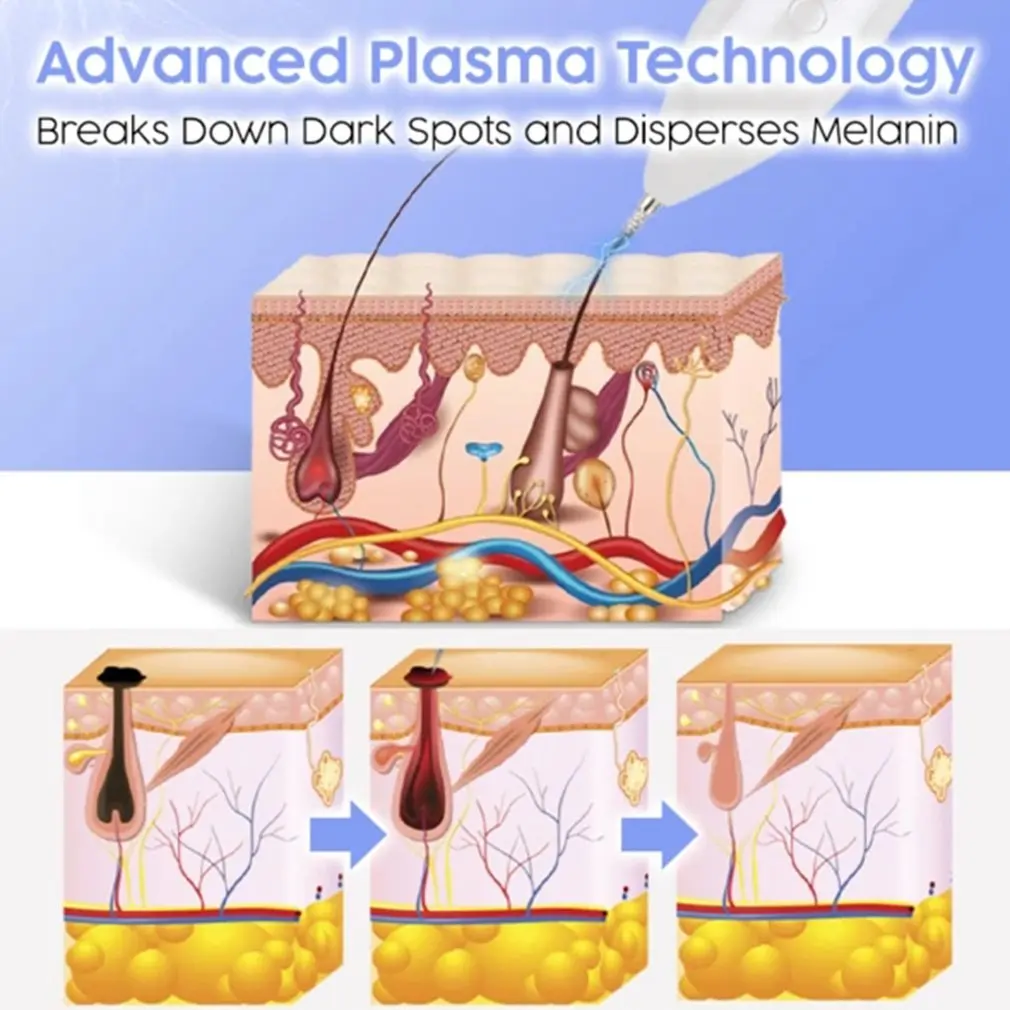 

Skin Care Dark Spot Removal Pen Freckle Remove Machine Face Wart Nevus Tattoo Dot Mole Remover Pen Salon Home Beauty Care