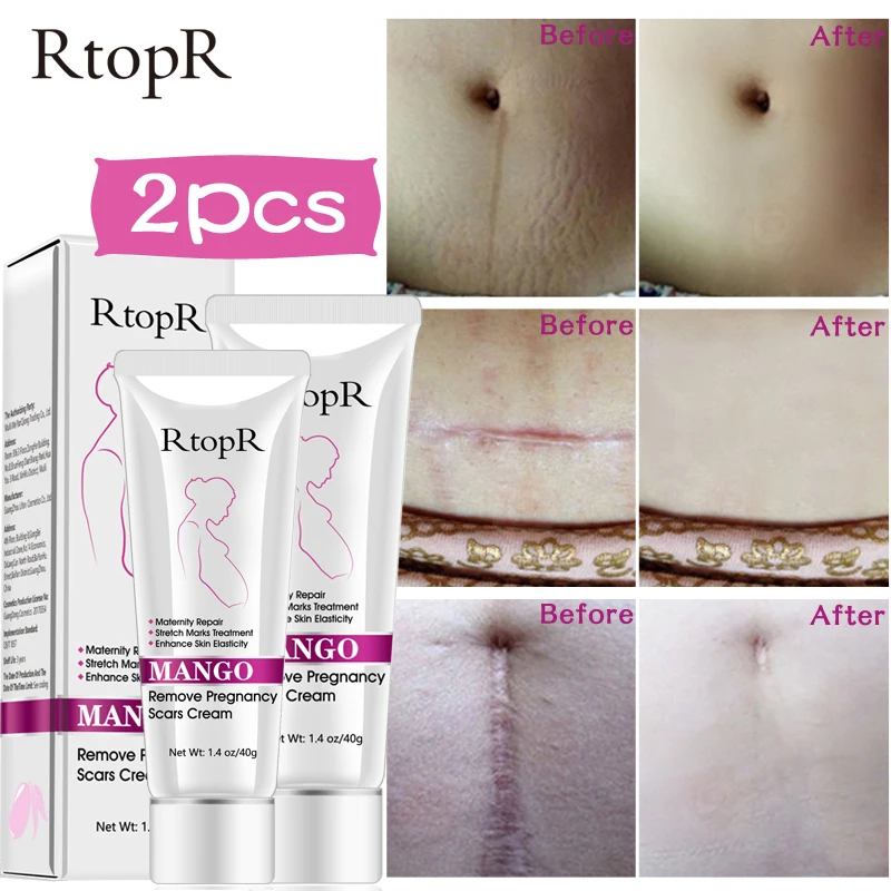 RtopR восстанавливающий крем для удаления шрамов беременных лечение акне против