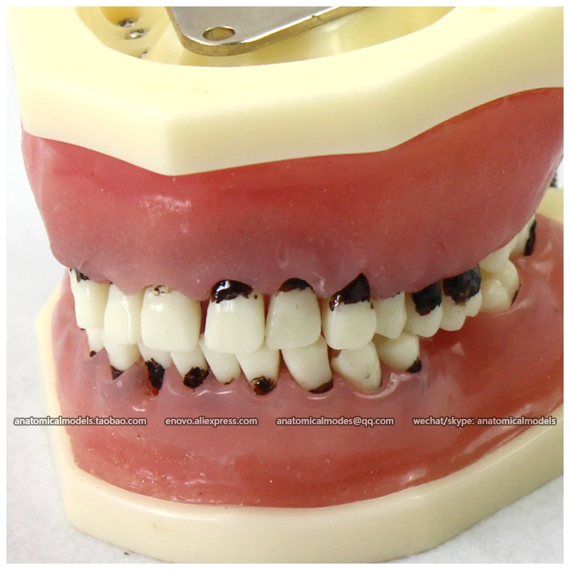 CMAM-22304 Серьезные Заболевания Пародонта Щековая Модель Хирургии Обучение |