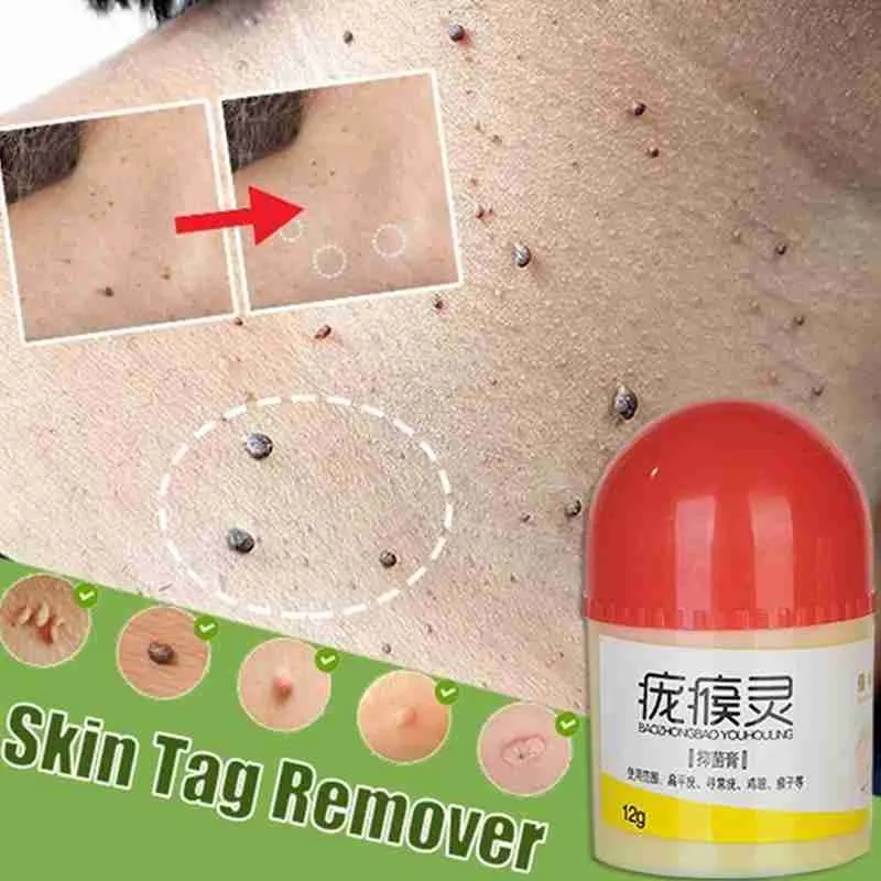 

Papillomas for Wart Treatment, Skin Wart Removal, Skin Marks