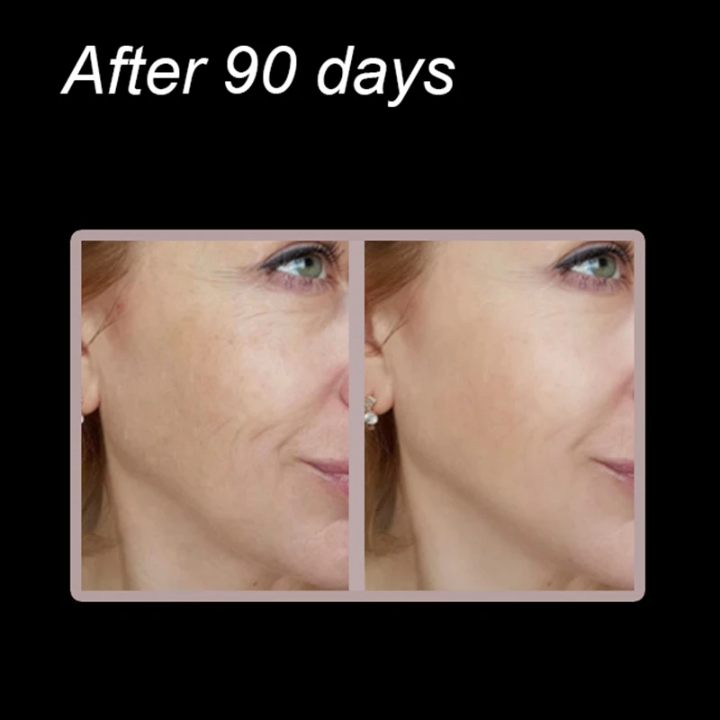 

EMS Facial Slimming V-Face Lifting Belt Machine Photon Infrared Therapy er Reduce Double Chin Neck Anti Wrinkle