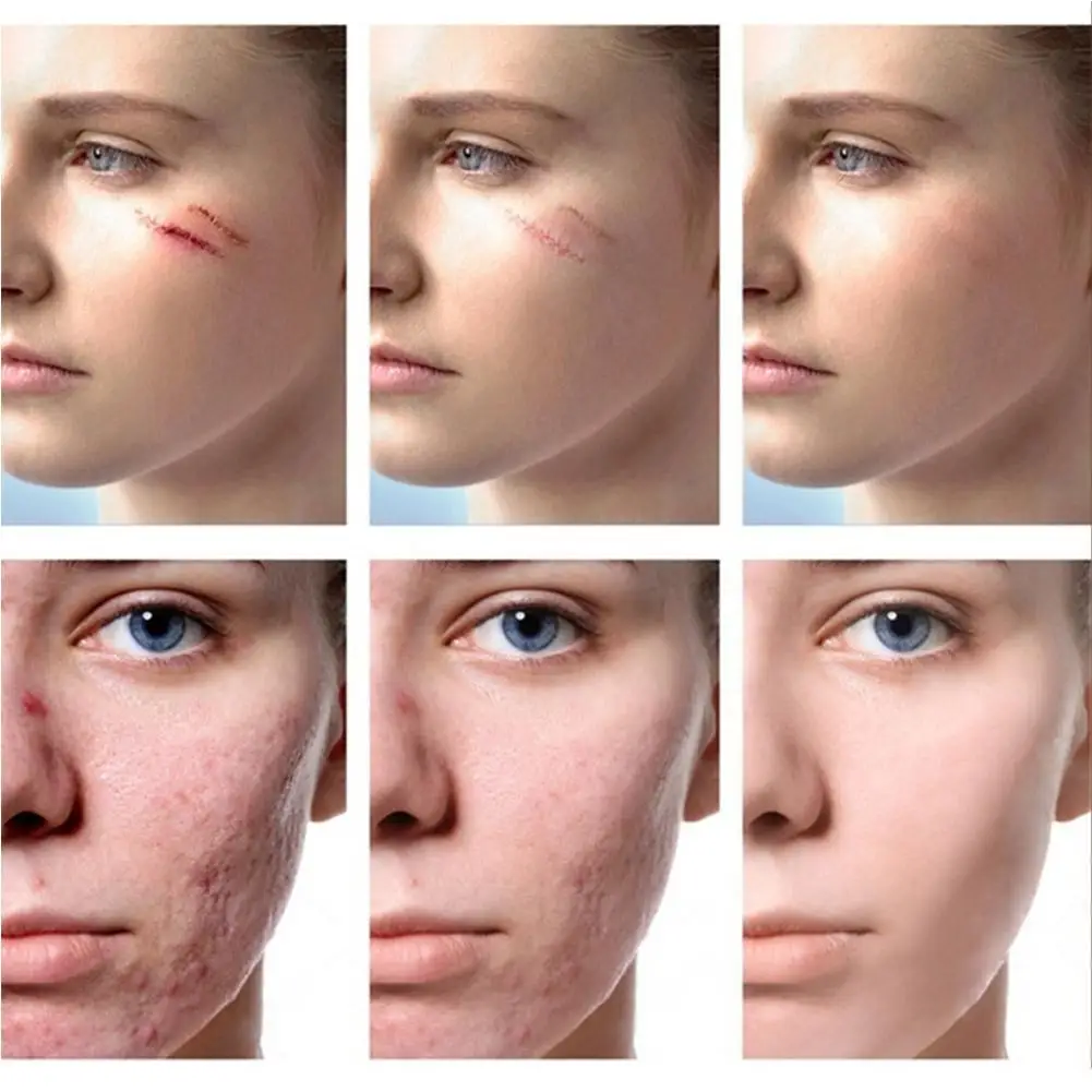 

Blackhead Removal Acne Treatment Cream Anti Pimples Shrink Scars Oil Whitening Spot Pores Acne Anti Moisturizer Cream Contr G3U5