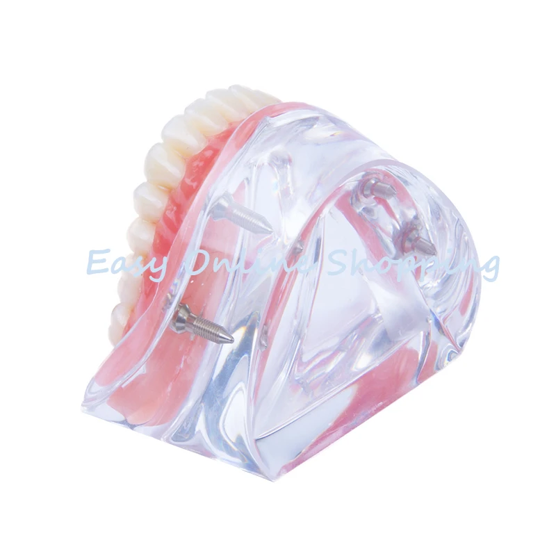 LOSUNCARE 1 шт. модель зубного протеза съемный внутренний мандибуляр с 4 имплантатами