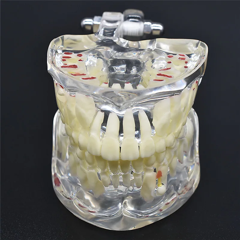 

Модель зубного протеза для детей, модель зубного протеза, прозрачная модель зубного протеза для обучения стоматологии