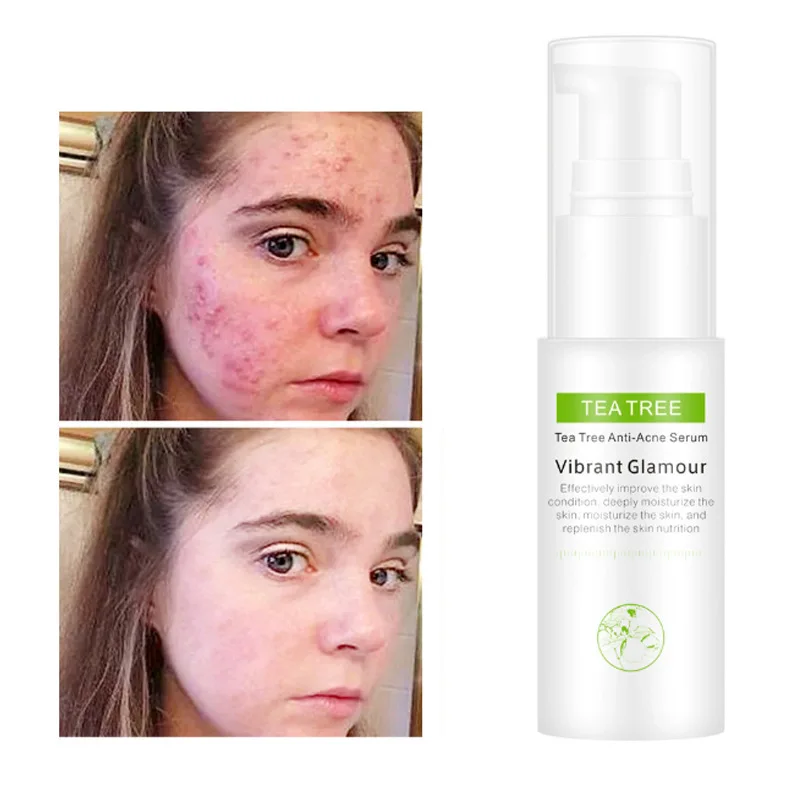 

30ml Tea tree acne repair water toner Reduce acne marks toner facial Skin care beauty products skin care products