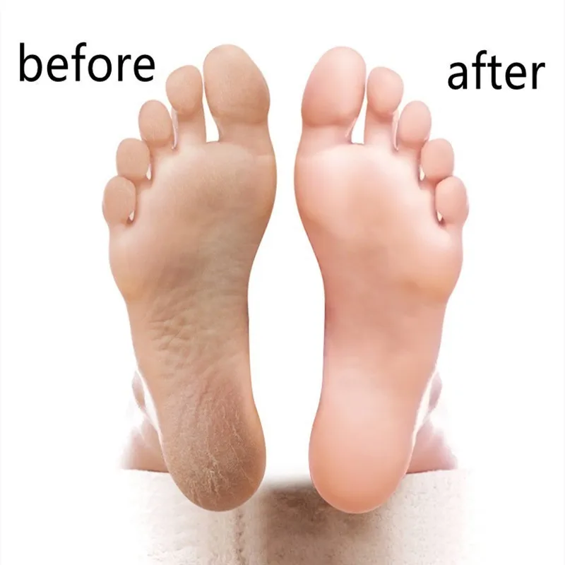 Профессиональный инструмент для удаления мозолей из нержавеющей стали грубой