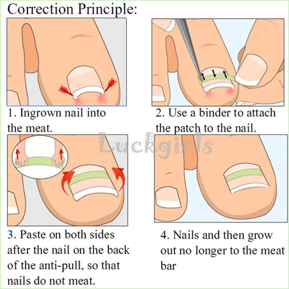 

12pcs/1 Set Ingrown Toenail Correction Set Paronychia Elastic Patch Straightening Stickers (Mild)